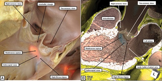 The images show the boundaries of the infero-septal recess of the left ventricle. (A) is a short-axis section of the base of the ventricular cone viewed from the apex. This shows how the attachment of the septal leaflet of the tricuspid valve separates the septum into its atrioventricular and interventricular components. (B) This in the virtual dissection, wherein the location of the membranous septum has been emphasized.
