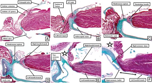 The images show a series of sections taken across the paraHisian regions from a dataset prepared from a human foetus obtained at 25 weeks of gestation. (A) The most inferior section, which is through the inferior paraseptal region. The fibroadipose of the inferior pyramidal space separates the atrial and ventricular walls. Cranial to this section, at the apex of the triangle of Koch, as seen in (B), is found the compact atrioventricular (AV) node. The inferior extent of the infero-septal recess of the left ventricle is already obvious. (C) How the axis penetrates through the membranous part of the septum to reach the crest of the muscular ventricular septum. The axis then divides into its right and left branches directly beneath the aortic root, as shown in (D). The sections taken still more cranially, as seen in (E,F), show how the area is paraseptal, with the white star with black borders showing the right atrioventricular groove. As indicated by the double headed arrow in (F), the attachment of the right coronary aortic leaflet is some distance away from the superior fascicle of the left bundle branch. The star shows the transverse sinus of the pericardium, marking the location of the inner heart curvature.