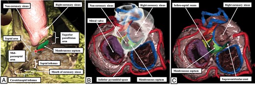 The virtual dissections show the anatomical relationships of the para-Hisian regions, which are made up of the septal component of the atrioventricular junctions together with the superior para-Hisian area and the upper third of the mid-paraseptal area. (A) A view from the right side having cut away the parietal walls of the right atrial and ventricular chambers. (B,C) Views of the atrioventricular junctions from the atrial aspect, with the right hand panel cut deeper to show the infero-septal recess of the left ventricle interposed between the aortic leaflet of the mitral valve and the muscular ventricular septum.