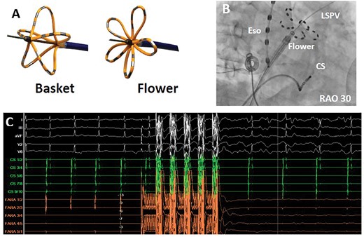 The new Farapulse-Farawave© pulsed field ablation catheter. (A) The Farawave (Farapulse©) catheter in its two application shapes (basket and flower). (B) Fluoroscopy in RAO 30° showing the Farawave catheter in the flower shape at the ostium of the left superior pulmonary vein. (C) Electrical isolation of a pulmonary vein induced by a pulsed field ablation application. Shown are surface electrocardiogram leads (white), coronary sinus leads (green), and Farawave catheter leads (orange). CS, coronary sinus catheter; Eso, oesophageal temperature probe; LSPV, left superior pulmonary vein; RAO, right anterior oblique.