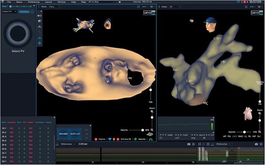 Three-dimensional imaging of the left atrium applying the KODEX-EPD system. Three-dimensional imaging of a left atrium applying the KODEX-EPD system. The left atrium is shown in a panoramic view and in an anterior–posterior orientation (left panel) and in a left anterior oblique view (right panel). LAA, left atrial appendage; LIPV, left inferior pulmonary vein; LSPV, left superior pulmonary vein; MV, mitral valve; RIPV, right inferior pulmonary vein; RSPV, right superior pulmonary vein.