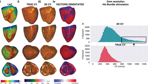 Two millimetre resolution, sinus activation. Note that as resolution progressively decreases, multiple small areas of early activation or ‘breakout’ are removed as resolution decreases, the percentage of faster CV when 2D CV increases and the proportion of CV vectors that are >30° increases. CV, conduction velocity; 2D, two-dimensional; 3D, three-dimensional.