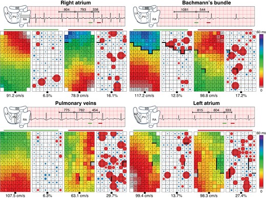 Examples of SR beats and PACs recorded at various atrial sites. Four examples of 5 s SR recordings including PACs and corresponding colour-coded activation (left) and LDH (right) maps. Black arrows represent the direction and magnitude of local CV, white arrows indicate LDH. Thick black lines in the activation maps correspond with conduction block according to a time difference between adjacent electrodes of ≥12 ms. Circles represent the degree of heterogeneity of vectors, in which the red colour indicate LDH. The size of the circles represents the degree of vector heterogeneity. Upper left panel: recording of one RA location in a 54 year-old female with AVD and paroxysmal AF a SR beat (cycle length 793 ms) followed by a PAC (cycle length 338 ms, prematurity index 57%). The origin of the PAC is unknown. Compared with SR, the PAC provoked 9.6% more LDH and decreased CV by 12.3 cm/s. Right upper panel: recording of a BB location in a 63 year-old male with MVD without history of AF during a SR beat (cycle length 1081 ms) followed by a PAC (cycle length 554 ms, prematurity index 49%). Origin of the PAC is presumably left-sided. Compared with SR, the PAC provoked 4.7% more LDH and reduced CV by 18.4 cm/s. Left lower panel: recording of a PV location in a 63 year-old male undergoing CABG without history of AF during a SR beat (cycle length 782 ms) followed by a PAC (cycle length 454 ms, prematurity index 42%). Origin of the PAC is presumably left-sided. Compared with SR, the PAC provoked 23.4% more LDH and reduced CV by 44.4 cm/s. Right lower panel: recording of a LA location in a 72 year-old male with AVD without history of AF during a SR beat (cycle length 804 ms) followed by a PAC (cycle length 333 ms, prematurity index 59%). Origin of the PAC is presumably left-sided. Compared with SR, the PAC provoked 13.7% more LDH and reduced CV by 9.1 cm/s. AF, atrial fibrillation; AVD, aortic valve disease; BB, Bachmann’s bundle; CABG, coronary artery bypass grafting; CV, conduction velocity; LA, left atrium; LDH, local directional heterogeneities; MVD, mitral valve disease; PAC, premature atrial contraction; PV, pulmonary vein area; RA, right atrium; SR, sinus rhythm.