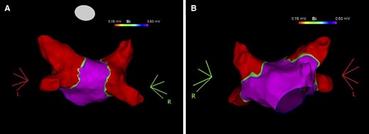 Post-ablation voltage map of the left atrium. Voltage map of the left atrium in postero-anterior (Panel A) and antero-posterior (Panel B) views showing pulmonary vein isolation after ablation with the radiofrequency balloon catheter.