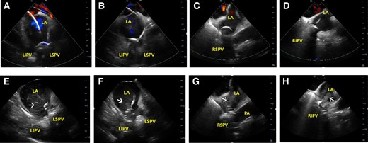 Intracardiac echocardiographic images. Colour Doppler images during pulmonary vein (PV) occlusion and blood bubbles (arrows) from PV after deflation of cryoballoon at the LSPV (A and E), LIPV (B and F), RSPV (C and G), and RIPV (D and H). LA, left atrial; LIPV, left inferior pulmonary vein; LSPV, left superior pulmonary vein; PA, pulmonary artery; RIPV, right inferior pulmonary vein; RSPV, right superior pulmonary vein.