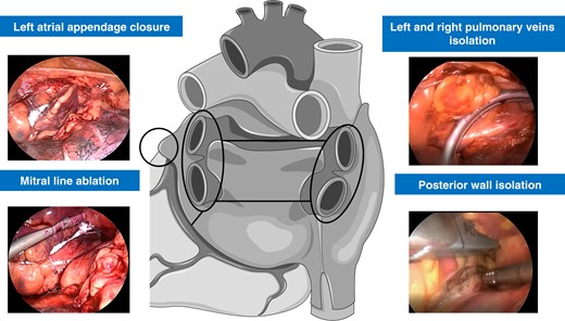 Epicardial thoracoscopic stage in hybrid atrial fibrillation ablation. Left and right pulmonary veins isolation and posterior wall isolation were performed in all patients. Left atrial appendage closure and posterior mitral line epicardial ablation were performed if clinically indicated.