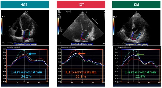 Representative images of LA reservoir strain in three cases with AF. The arrow indicates the average LA reservoir strain. AF, atrial fibrillation; DM, diabetes mellitus; IGT, impaired glucose tolerance; LA, left atrium; NGT, normal glucose tolerance.