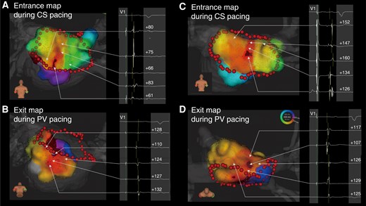Bidirectional activation maps of the electrical conduction gap. (A, B) Example of a short gap length at the bottom lesion. (C, D) Example of a long gap length at the roof lesion. CS, coronary sinus; PV, pulmonary vein.