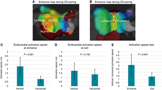 Three-dimensional map showing the anisotropic property of the electrical activation speed at the left atrial posterior wall. (A, B) The endocardial activation speeds in the vertical direction are faster than those in the horizontal direction, whereas the endocardial activation speeds in the horizontal direction did not differ between the rightward and leftward directions. (C) The endocardial activation speed at the entrance into the box lesion is 2.3 ± 1.1 m/s in the vertical direction and 0.8 ± 0.4 m/s in the horizontal direction (P < 0.001). (D) The endocardial activation speed at the exit from the box lesion is 1.7 ± 0.9 m/s in the vertical direction and 1.4 ± 0.6 m/s in the horizontal direction (P = 0.100). (E) The activation speed ratios between the vertical and horizontal directions are 3.1 ± 1.6 at the entrance and 1.4 ± 0.6 at the exit (P < 0.001). CS, coronary sinus.