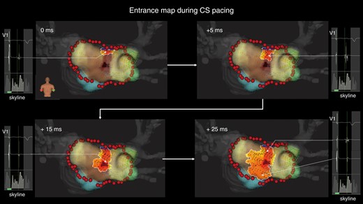 Representative case of epicardial conduction visualization during coronary sinus pacing. The entrance identified by the standard algorithm is at the centre of the box lesion. In the LUMIPOINT activation algorithm, electrical activation conducts linearly, from the roof line to the entrance, and centrifugally. The electrograms highlighted by the LUMIPOINT activation algorithm and the Skyline histogram are also shown. CS, coronary sinus.