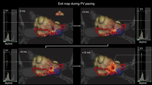 Representative case of epicardial conduction visualization during pulmonary vein pacing. The exit identified by the standard algorithm is located away from the roof ablation line. In the LUMIPOINT activation algorithm, electrical activation is conducted continuously from the roof line to the exit and is then conducted centrifugally. The electrograms highlighted by the LUMIPOINT activation algorithm and the Skyline histogram are also shown. PV, pulmonary vein.
