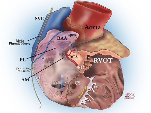 Attitudinal view of the right atrium demonstrating the three proposed optimal locations for the implantation of an atrial leadless pacemaker; (1) anteromedial RAA apex, (2) base of the RAA, (3) right atrial lateral wall. AM, anteromedial (aspect of the RAA); CS, coronary sinus; CT, crista terminalis; EV, eustachian valve; IVC, inferior vena cava; PL, posterolateral (aspect of the RAA); RAA, right atrial appendage; RCA, right coronary artery; RVOT, right ventricular outflow tract; SB, septal bundle; SC, supraventricular crest; SVC, superior vena cava; TV, tricuspid valve.