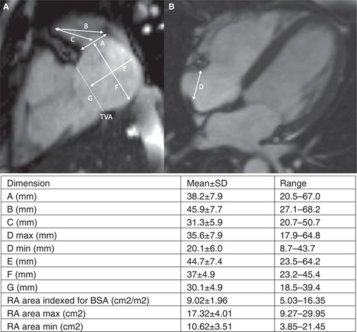 Cardiac MRI dimensions analysed. Representative MRI images demonstrating the measurements taken and the resultant mean measurement; (A) two-chamber view. (B) Four-chamber view. Measurements noted: A—RAA ostium, B—RAA depth to CT, C—RAA depth to mid-point of RAA ostium, D—CT to lateral TVA, E—RA diameter (2Ch view) perpendicular to TV annulus, F—RA diameter (2Ch view) perpendicular to RAA ostium, G—TVA diameter (2Ch view). BSA, body surface area; CT, crista terminalis; MRI, magnetic resonance imaging; RA, right atrium; RAA, right atrial appendage; TVA, tricuspid valve annulus.