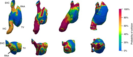 3D collision analysis: representative images from four patients of the collision analysis from 3D modelling in a right lateral (top) and superior (bottom) view demonstrating the incidence of collision of the virtual device implant throughout the cardiac cycle. A 0% incidence of contact throughout the cardiac cycle is represented in blue with a continuous scale to 100% contact throughout the cardiac cycle in dark red. (The three suggested implant locations for an atrial leadless pacemaker in this collision model are shown in supplementary material online, Figure S2.) IVC, inferior vena cava; RAA, right atrial appendage; SVC, superior vena cava; TV, tricuspid valve.
