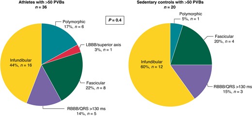 Prevalent morphologies of ventricular arrhythmias among 36 athletes and 20 sedentary controls with >50 isolated PVBs. LBBB, left bundle branch block; PVBs, premature ventricular beats; RBBB, right bundle branch block.