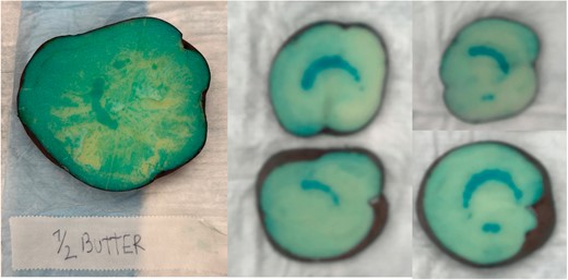 Significant lesion dampening observed in the presence of butter (mimicking intramyocardial fat characteristics).
