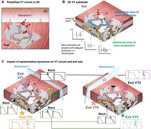 Modulation of VT circuits by repolarization dynamics: in presence of scar, both anatomical fixed and functional lines of block are likely to contribute to initiation and maintenance of VAs. The spatial and temporal gradients of repolarization may dictate and modulate the exact VT circuit. (A) A traditional simplified 2D schematic of a complex patch of scar (grey) with conducting channels. An approaching wavefront meets sites of functional block at ‘site A’ but ‘enters’ a conducting channel at ‘site C’. Sites D and E are bystanders. At ‘site G’, functional block occurs due to still refractory tissue at site C. In turn, by the time it arrives at ‘site F’, the opposing site A has regained excitability and the impulse conducts back and allows initiation of a re-entry (A = exit site). (B) Ventricular scar is a complex 3D construct with channels not only along the surface but also extending intramurally. (B) How the presumed ‘dead-end’ bystanders at sites D and E in panel (A) could lead towards intramural channels with equally delayed conduction that may result in alternative circuits either leading back to the original surface (green) or with exit sites to the opposing surface (yellow). Mapping may indicate late potentials and fractionation at all these channels. Bottom (C) Illustration of the role of repolarization dynamics in modulating VT exit site: different sites may display distinct APD durations and/or accentuated beat-to-beat variation: Left: Wavefront 1 may meet refractory tissue at some of the channels (black) yet timing may be right at others (e.g. blue exit VT1, green exit VT2, and yellow exit VT3). Right: A ‘different’ wavefront, e.g. change of direction or coupling interval and/or changes in autonomic tone, may unmask alternative VT circuits due to the dynamic changes in repolarization timing which could modulate the exit site. As schematically shown here, the wavefront now meets refractory tissue at the previous exits but allows the impulse to travel through to VT 4–6.