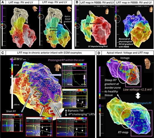 Examples of 3D repolarization maps in normal and diseased hearts. Top Left (A) A structurally normal heart assessed with high-density conduction and repolarization mapping demonstrating interventricular right-to-left and intra-ventricular apico-basal gradients (transmural epi-to-endocardial not shown).11–13,46–48 In the intact heart, the transmural repolarization gradient is thought to contribute comparatively little (13%) to the total dispersion of repolarization, whereas apico-basal, interventricular and anterior posterior gradients are thought to contribute the majority (87%)49 Top Right (B) DCM patient with mid-septal fibrosis and right bundle branch block showing an accentuation of the repolarization gradients and reversal of the right–left activation and repolarization sequence. Note: different colour scales for LAT and LRT. Bottom (C) High-density repolarization map in a patient with anterior myocardial infarction. Significantly delayed repolarization times in the anterior scar area (purple) with fractionated prolonged QRS in the unipolar EGMs reaching >220 s and pushing the repolarization time to the edge of the WOI that is possible to set up (maximum + 500 ms). Steep gradients can be appreciated at the border zone of the scar with biphasic T waves causing challenges for precise LRT annotation. (D) Low-voltage zone secondary to an apical infarct co-locates to areas of prolonged repolarization and steep gradients at the border zone.