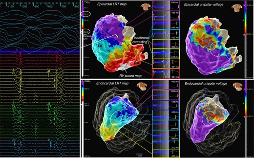 Example of iREM: a patient with left-sided ACM, inferolateral mid- and subepicardial scar in MRI, fast VT, and episodes of ventricular ectopy-triggered VF. High-density repolarization mapping was performed as described, with LRT map shown and total repolarization time displayed over eight isochrones (here 221 to 500 ms). A zone of isochronal crowding was identified at the inferior base at the border zone of the unipolar low-voltage area (white circle) allowing to quickly identify an area of abnormally steep repolarization gradients leading towards a zone of substantially prolonged repolarization corresponding to the area of scar as indicated in the voltage map. Bottom The corresponding LV endocardial LRT map equally displays a zone of isochronal crowding at the border zone in the mid-inferolateral segment albeit much more discrete. A fast VT (tachycardia cycle length 250 ms) was induced with loss of cardiac output, the HD grid overlaying the area of late repolarization adjacent to the iREM area recorded mid/end-diastolic potentials, with ATP the VT degenerated to VF and required DCCV. Activation sequence of the HD grid suggested conduction from area of late activation towards iREM.