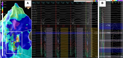Example of T wave alternans displayed as ‘colour disarray’ on 3D map. Left (A) Discordant alternans of the T wave recorded by the HD grid. During stable cycle length and QRS morphology, alternating T wave polarity is recorded highlighting the challenges of sequential LRT mapping during ventricular substrate mapping. Right (B) T wave polarity change recorded across the splines of the HD grid (negative on Spline 1 to positive on Spline 4). Repolarization starts when the net of outward currents begins to exceed the inward current of the AP, which is a much slower process than the rapid activation and upstroke in Phase 0. A positive T wave reflects the current flowing towards the recording site, e.g. repolarization at this site occurs earlier, whereas the more negative, the later the repolarization occurs51—the high-density mapping catheter is able to record this changes and phenomenon during contact mapping.