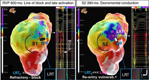 Concept of re-entry vulnerability index. Left A LAT map acquired during straight RV pacing at 600 ms (S1) shows a line of block and adjacent area of late activation on the anterior LV wall (blue/purple, point A). The adjacent area (point B) is still refractory at the time the late activating area is activated (LRTB > LATA). Right A critically timed sensed extra ‘S2’ with coupling interval at 390 ms elicits decremental conduction. The wavefront pivots around the line of block wavefront arriving now with a delay of over 300 ms in the late activating area and meets re-excitable tissue at the opposing side of the (unidirectional line of block (LRTB < LATA) and thus predisposes to re-entrant tachycardia.