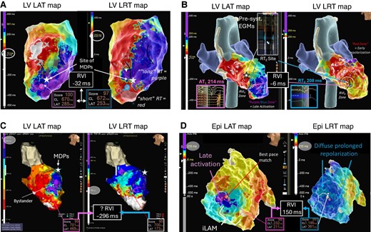 Example of RVIV mapping in ischaemic and non-ischaemic substrates. (A) Ischaemic LV substrate. Evidence of extensive areas of late activation with a broad deceleration zone (marked with black lines) in LAT map. Corresponding LRT map suggests a very steep gradient at the border zone of the scar large anterior scar and a visual RVI zone (purple and blue circles) is identified towards the anterior apical segment with calculated RVI −32 ms within ATL and RTE < 5 mm (‘very high vulnerability’). The white star indicates the location of mid-diastolic potentials during the VT. (B) Burned-out HCM: Again extensive area of scar in the LV apex with late activation and a deceleration zone rotating around a line of block in the septo-apical segment. An adjacent zone of early repolarization allows to locate a visual RVI zone (white dashed circle) with estimated RVI of −6 ms. During VT mapping, presystolic EGMs were recorded just slightly superior to the RVI. (C) False-positive RVI in an ischaemic substrate with anterior LV aneurysm with excessive delay of >400 ms into the aneurysm sack. Highest re-entry vulnerable zone was identified at the mid-anteroseptal edge of the aneurysm with RVI −296 ms across a line of block. Re-entry around the neck of the anterior-basal edge of the aneurysm was mapped and terminated with ablation (not shown here). Ablation at the base of the aneurysm neck electrically isolated the entire aneurysm confirming a true anatomical (as opposed to functional) line of block and unmasking the original RVI1 site as false positive. (D) ‘Unsuccessful’ RVI mapping in a patient with arrhythmogenic right ventricular cardiomyopathy (ARVC) and VT. Zone of deceleration and late activation on RV free wall of epicardial LAT map but no adjacent sites of early repolarization on LRT map. The possibility of an intramural re-entry vulnerable site needs to be considered, and possible combining endo- and epicardial LAT and LRT maps may increase the success rate of RVI mapping in these patients.