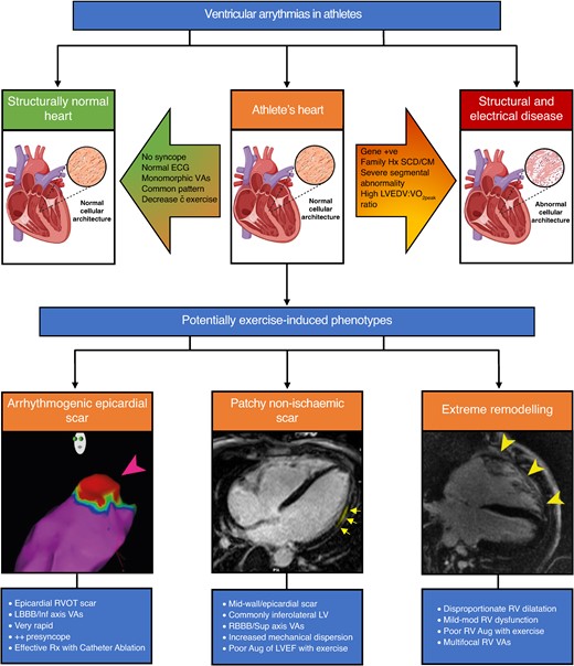 Ventricular arrhythmias in athletes. VAs can be found in athletes with structurally normal hearts, those with underlying structural/electrical heart disease or athlete’s heart. Various factors can help differentiate benign athletic remodelling from structural disease. Under the umbrella term of athlete’s heart are potentially exercise-induced phenotypes including arrhythmogenic epicardial scar, patchy non-ischaemic scar (e.g. non-ischaemic LV scar), and extreme remodelling (e.g. exercise-induced arrhythmogenic cardiomyopathy). ECG, electrocardiogram; VAs, ventricular arrhythmias; SCD, sudden cardiac death; CM, cardiomyopathy; LVEDV, left ventricular end-diastolic volume; VO2Peak, absolute peak VO2; RVOT, right ventricular outflow tract; LBBB, left bundle branch block; Rx, treated; LV, left ventricle; RBBB, right bundle branch block; Aug, augmentation; LVEF, left ventricular ejection fraction; RV, right ventricle. Image created with BioRender.com.