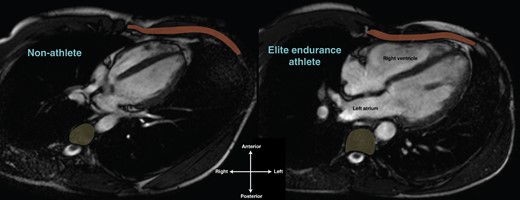 The athlete's heart within the thorax. Horizontal long axis cardiac MRI of a non-athlete (left) and elite endurance athlete’s heart (right), both 24-year-old males. Compared to the non-athlete, note the significantly greater proportion of the thorax inhabited by the athlete’s heart and the intimate relationship between the right ventricle and the chest wall (anterior, rust) and the left atrium and thoracic vertebrae (posterior, yellow). The right ventricle and left atrium of the athlete’s heart appear to be deformed in shape compared to the non-athlete.