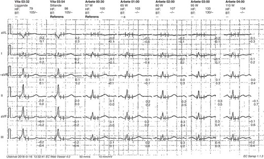 Sudden loss of pre-excitation during EST in an asymptomatic patient. EST, exercise stress test.