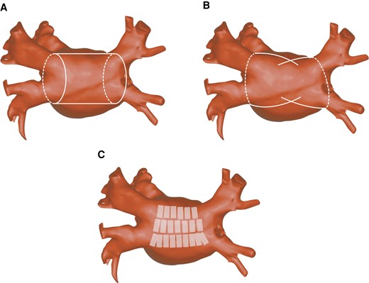Posterior view of the left atrium showing epicardial lesion sets during thoracoscopic surgical AF ablation: pulmonary vein isolation with connecting roof and inferior lines (A), en-bloc pulmonary vein and posterior wall isolation using the Cardioblate Gemini-S (Medtronic Inc.) RF ablation system (B), and posterior wall ablation using the convergent approach (C). AF, atrial fibrillation; RF, radiofrequency.
