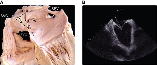 (A) Anatomy of interatrial septum and optimal site of transseptal puncture (demarcated with a brace). Black arrow in the dotted area shows the infolded groove of the atrial wall between the SVC and the right PVs filled with extracardiac fat tissue. (B) Intracardiac echo view of typical tenting before transseptal crossing. Modified from Tzeis et al.159 IVC, inferior vena cava; LIVP, left inferior pulmonary vein; LSVP, left superior pulmonary vein; PV, pulmonary vein; RIVP, right inferior pulmonary vein; RSVP, right superior pulmonary vein; SVC, superior vena cava