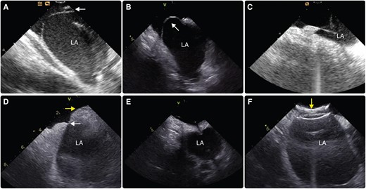 Anatomic variations of the interatrial septum that may be encountered during transseptal puncture. (A) Patent foramen ovale (white arrow); (B) septal aneurysm with large excursion towards the right atrium (white arrow); (C) tenting of floppy septum from transseptal needle close to the left atrial wall; (D) very small fossa ovalis (white arrow) in a patient with lipomatous septal hypertrophy (yellow arrow); (E) standard transseptal needle crossing a pericardial patch; (F) atrial septal closure device (yellow arrow) covering almost all of the interatrial septum. LA, left atrium.