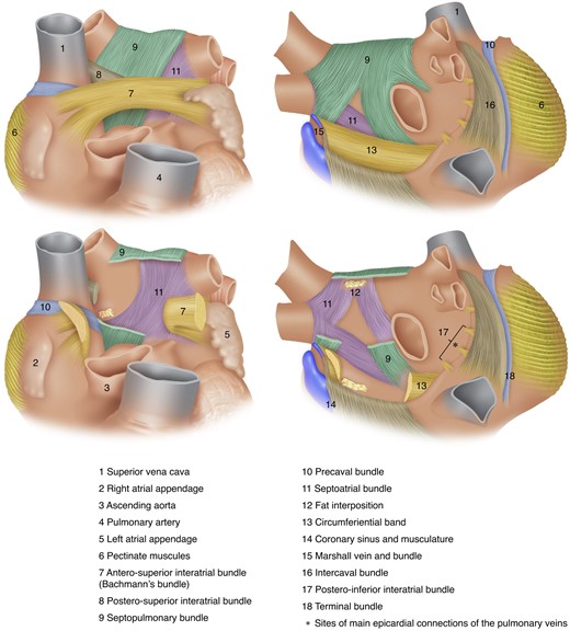 Architecture of atrial musculature. Upper left: main atrial muscular bundles from anterior view. Lower left: transection of the Bachmann's bundle, postero-superior interatrial bundle, and the septopulmonary bundle enables visualization of the septoatrial bundle. Upper right: main atrial muscular bundles from posterior view with slight rightward tilting—the stars denote epicardial connections of the right PVs with the right atrium and left atrium posterior wall. Lower right: transection of the septopulmonary bundle coursing epicardially enables visualization of the septoatrial bundle and neighbouring fat inter-position. PV, pulmonary vein.