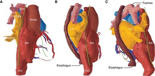 Course of the right phrenic nerve in relation to neighbouring structures in different projections (A: right anterior oblique; B: right lateral; C: right posterior oblique)—reconstruction from computed tomography scan. IVC, inferior vena cava; LA, left atrium; RA, right atrium; RIPV, right inferior pulmonary vein; RSPV, right superior pulmonary vein; SVC, superior vena cava.
