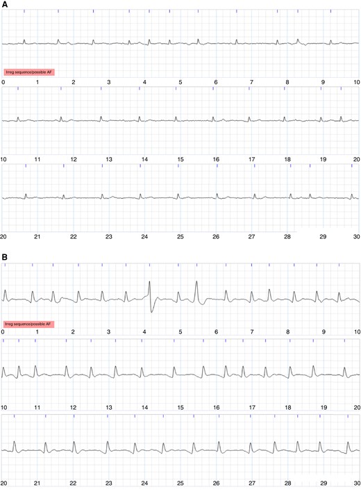 Examples of single-lead ECGs on which the cardiologists agreed. Each image shows a 30-s ECG, with 10 s per line. (A) Agreed diagnosis of non-AF. (B) Agreed diagnosis of AF.