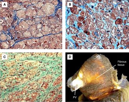 (A) Light microscopy image (Masson's trichrome stain) of atrial tissue with normal intercellular space (41 yo) and (B) cardiomyocyte loss with expansion of interstitial fibrous tissue (82 yo). (C) and (D): myofibrillar loss and fibrotic replacement in the aged left atrium. yo, years old.