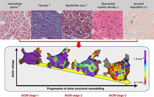 Histological factor associated with atrial structural remodelling characterized by electroanatomic mapping. The upper panel shows light microscopy images of atrial biopsy samples obtained from patients with non-valvular atrial fibrillation. The lower panel shows examples of high-density bipolar voltage map of the left atrium created during high right atrial pacing at 100 beats per minute. Not only fibrosis, but also increased intercellular space preceding fibrosis, myofibrillar loss, decrease in myocardial nuclear density, and amyloid deposition are associated with the progression of atrial structural remodelling.78 The rightmost image in the upper panel shows Congo Red staining, the second from the right shows haematoxylin and eosin staining, and the others show Masson's trichrome staining. The colour gradation in the lower panel voltage maps indicates differences in voltage amplitude from purple at 1.5 mV to grey at 0.1 mV, as shown in the colour bar. AtCM, atrial cardiomyopathy (see Table 2 for explanation of AtCM stages).