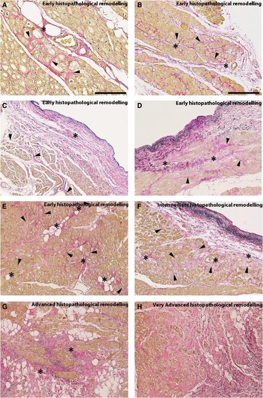 Microphotographs captured from left atrial biopsies belonging to patients suffering from long-lasting atrial fibrillation associated with severe mitral-valve regurgitation. These histopathological sections have been stained with a combined Weigert/Van Gieson dye where cardiomyocytes are highlighted in yellow-brown, collagen fibres in red, and elastic fibres in black. (A) Medium-power view of a developing Early-Stage histopathological remodelling (ATCM stage 1) where multiple foci of interstitial fibrosis (arrowheads) stem from the adventitia of a penetrating coronary branch (asterisk). (B) Low-power view of an incipient Early-Stage histopathological remodelling with multiple interstitial fibrosis foci (arrowheads) originating from a longitudinally oriented blood vessel (asterisks). (C) An initial Early-Stage AtCM histopathological remodelling with a fibroelastotic endocardial thickening (asterisk) from which newly deposed collagen fibres enlarge the adventitia of subendocardial blood vessels (arrowheads). (D) Incipient Early-Stage histopathological remodelling interstitial fibrosis (arrowheads) stemming from an endocardium thickened by fibroelastosis which had also enlarged local blood vessel adventitia (asterisk). (E) Early-Stage histopathological remodelling characterized by multiple foci of interstitial fibrosis (arrowheads) that had originated from sparse penetrating blood vessel adventitias (asterisks). (F) Another type of Intermediate-Stage histopathological remodelling (AtCM stage 2) compound interstitial fibrosis (arrowheads) which takes origin from two blood vessels and a thickened endocardium (asterisks). (G) Advanced-Stage histopathological remodelling characterized by confluent myocardiosclerotic foci (asterisks). H. Compact and diffuse areas of interstitial fibrosis (Very Advanced-Stage histopathological remodelling; AtCM stage 3). Staining. (A-G) Weigert/Van Gieson combined dye. Original magnifications. (A): ×20 (scale bar is 150μm); (B-G): ×10 (scale bar in (B) is 300μm).
