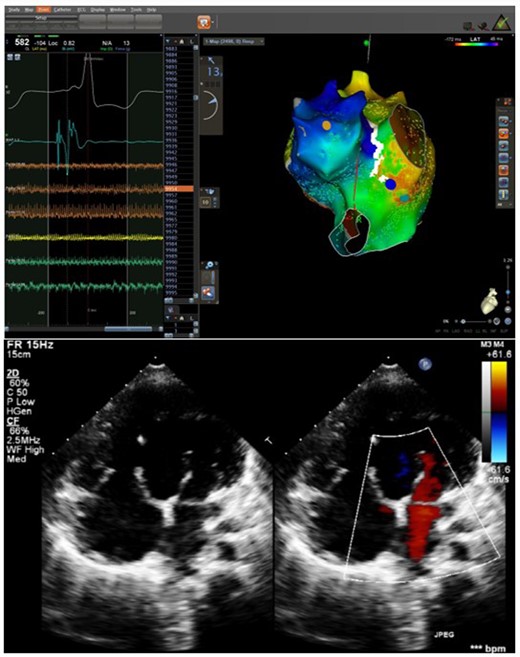 3D map & Echo in patient 2