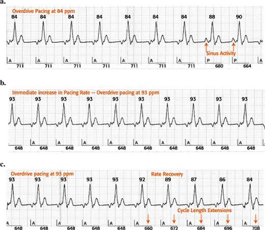 Operation of the AF Suppression™ Algorithm. When two P waves are sensed within 16 consecutive cardiac cycles (a), the device immediately paces the atrium at a higher rate (b) determined by the ongoing paced rate and the lower and upper rate overdrive settings. Overdrive pacing continues for a programmable number of cycles before slowing to a rate determined by rate recovery (c) and returning the device operation to the base rate , rest rate or sensor-indicated rate. Upon further sensing of spontaneous atrial events, the algorithm will return to overdrive pacing. See text for further explanations.