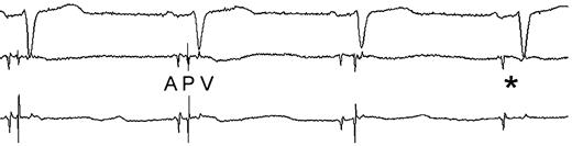 Recording of atrial (A), pulmonary vein (P), and ventricular (V) potentials during catheter ablation. Note the sudden change in the morphology (3rd complex), followed by disappearance (*) of the pulmonary vein potential.