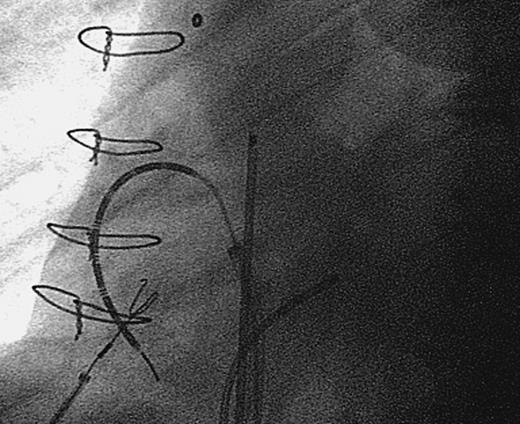 Radiographic appearance of linear radiofrequency catheter (Cardima Inc.) used to create a linear lesion between the inferior and superior venae cavae.