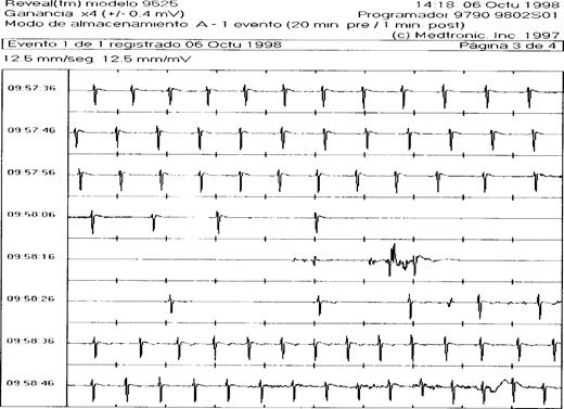 ILR registration of syncope due to paroxysmal sinus arrest. ECG registration of 80 s by the implantable loop recorder during episode of syncope. A gradual slowing of sinus rhythm is followed by an asystole of about 15 s before an escape rhythm starts. See text for discussion.