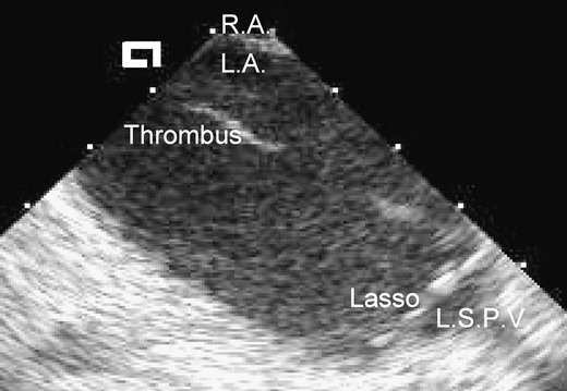 Phased-array intracardiac echo of left atrial thrombus. The intracardiac echo probe was positioned in the right atrium and the two-dimensional echo image is of the left atrium seen across the fossa ovalis (the echogenic linear structure at the top of the image between the labels R.A. and L.A.). R.A., right atrium; L.A., left atrium; L.S.P.V., left superior pulmonary vein; Thrombus, mobile strand of freshly formed thrombus which was attached to the shaft of a mapping catheter in the left atrium; Lasso, decapolar circumferential mapping catheter positioned at the ostium of the left superior pulmonary vein—four of the ten recording electrodes aligned orthogonally to the pulmonary vein ostium are seen in this two-dimensional echocardiogram.