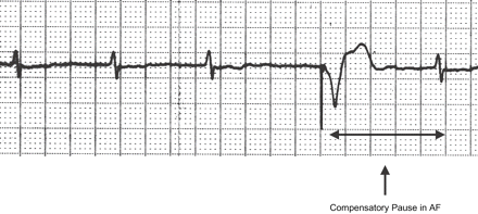 The spontaneous escape interval following the paced beat is by definition the CP in AF.