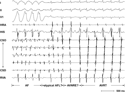 Tracing showed atrial fibrillation (AF) with accessory pathway conduction evolving into orthodromic atrioventricular reciprocating tachycardia (AVRT) via two intermediate rhythms: atypical atrial flutter-like (AFL?) tachycardia and slow–fast atrioventricular nodal reentrant echo-like (AVNRE?) beats. CSD, distal coronary sinus; CSO, ostium of coronary sinus; HIS, His bundle recording; HRA, high right atrium; RVA, right ventricular apex.