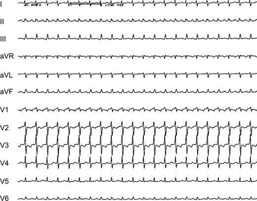 Twelve-lead ECG (25 mm/s) of a 70-year-old heart transplant recipient showing a supraventricular tachycardia (CL 360 ms). P waves appear positive in the inferior leads.