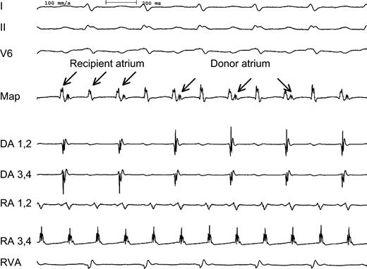 Intracardiac electrograms demonstrating recipient atrial tachycardia (RA) with 2:1 conduction to the donor atrium (DA). Three surface leads (I, II, V6), two bipolar recordings from the recipient atrium (RA, CL 180 ms) and two bipolar recordings from the donor atrium (DA, CL 360 ms) as well as a recording from the right ventricle (RVA) are shown. A bipolar recording at the mapping catheter (map) placed at the region of the suture line showed a fixed 2:1 coupling interval between the two atria during tachycardia.