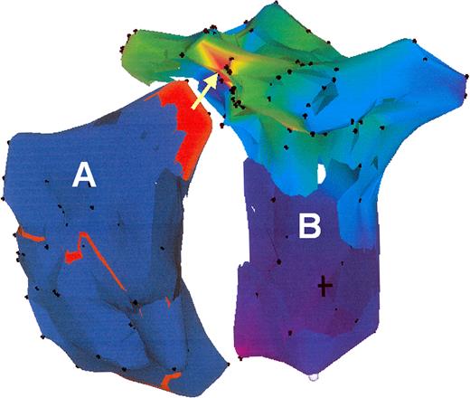 RAO view of a CARTO™ map of the tachycardia in the recipient atrium (A) and the donor atrium (B). In the recipient atrium the propagation map displayed an activation front (red) in the superior region. The activation map of the donor atrium confirmed an origin (red) of the tachycardia at the suture line at the region where the activation propagated in the recipient atrium (arrow).
