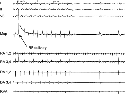 Termination of the tachycardia 4 s after RF delivery due to interruption of the transatrial conduction. This resulted in dissociated rhythms in the two atria. In the recipient atrium atrial flutter was unaltered, in the donor atrium a junctional rhythm occurred. RA, recipient atrium; DA, donor atrium; Map, mapping catheter.
